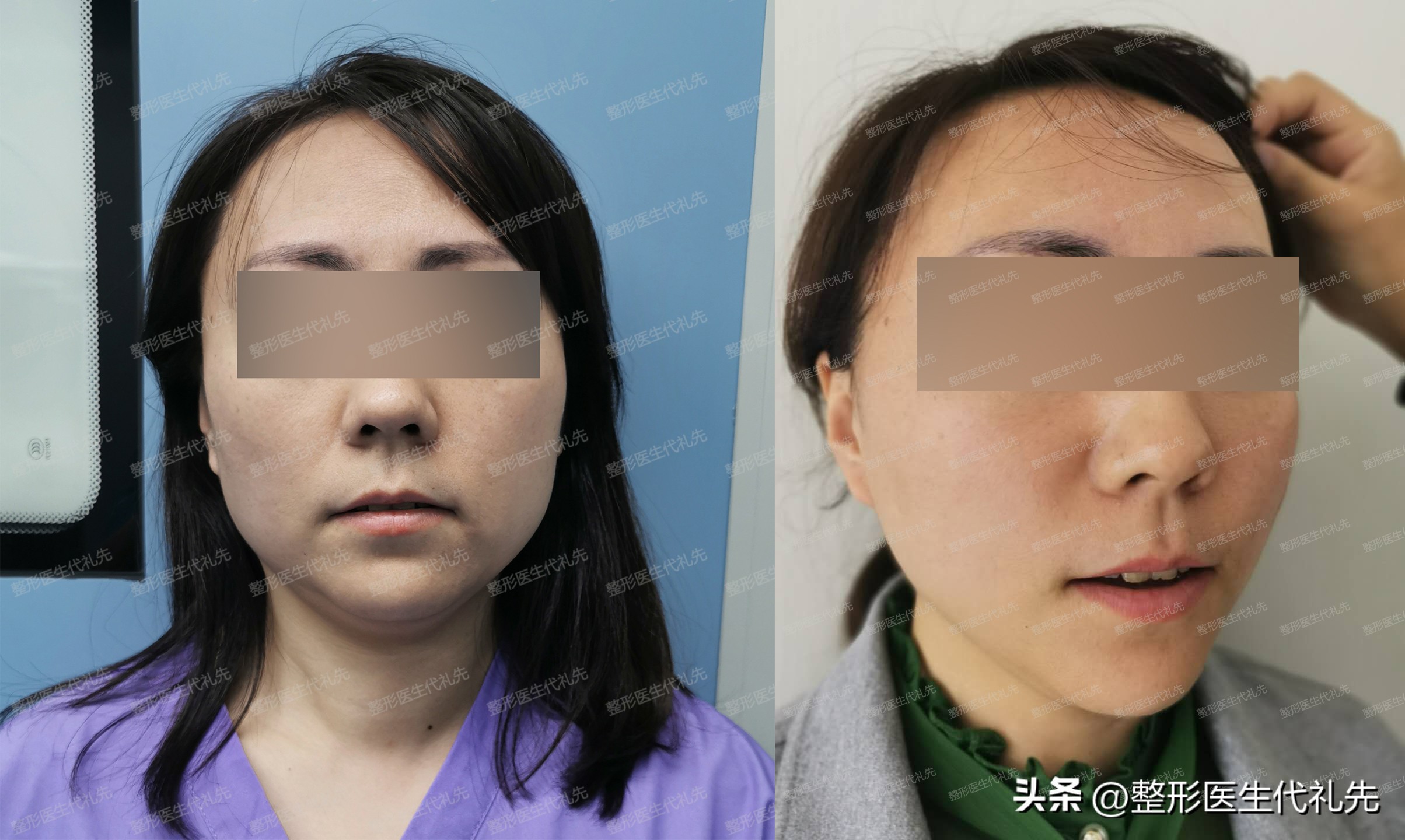 去眼袋外切是什么样的,做外切眼袋会改变眼睛的形状吗