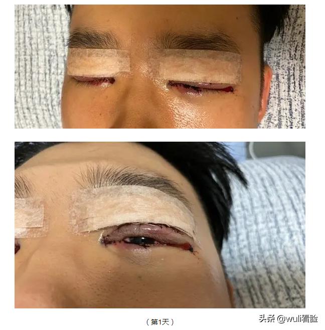 男生割双眼皮的意思,男生眼睛小割双眼皮会好看吗