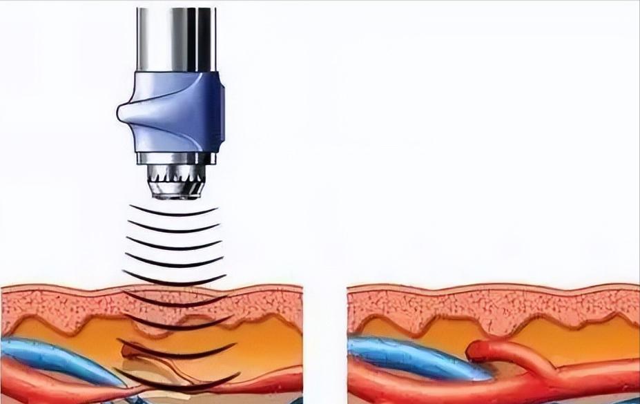 怎么缓解足底筋膜炎的疼痛,筋膜炎患者痛苦