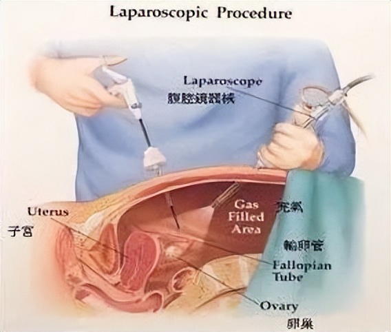 宫腔镜科普系列,宫腔镜和腹腔镜哪个比较好