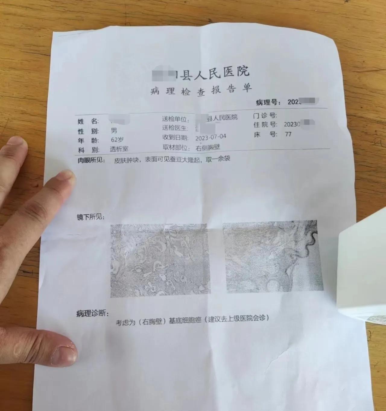 癌症诊断：县医院病理为基底细胞癌，省三甲结合免疫组化为良性瘤