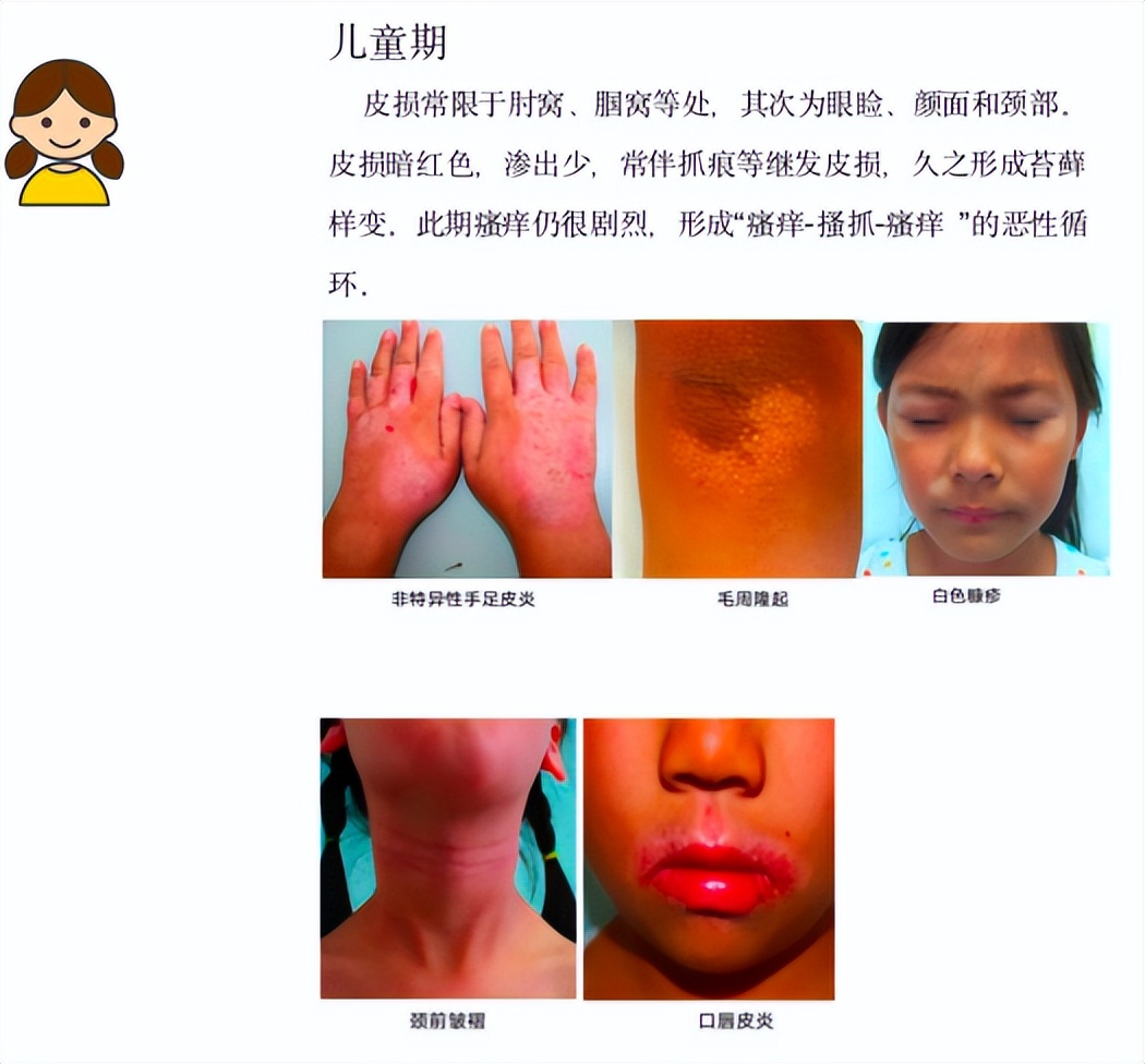 孩子得了过敏性皮炎需要忌口吗,儿科春季过敏