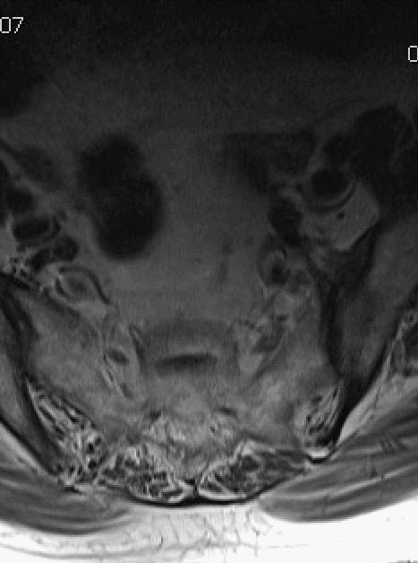 老年女性骶骨受侵椎管骶管内富血供占位影诊思维过程