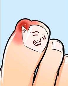 一走路脚趾甲痛,甲沟炎拔完脚趾甲很疼怎么办