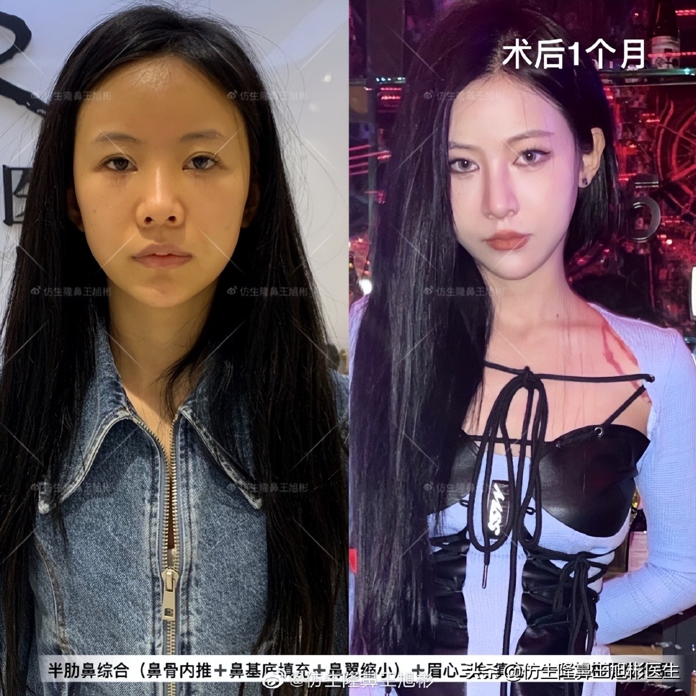 可以只做鼻头不放假体吗,只做鼻头鼻翼缩小手术多少钱