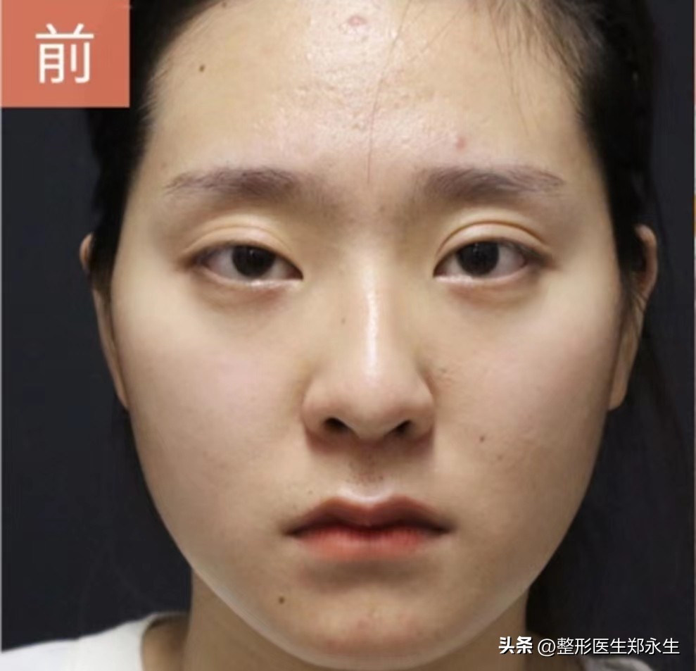 双眼皮修复手术真的很难吗,双眼皮整形真实修复过程