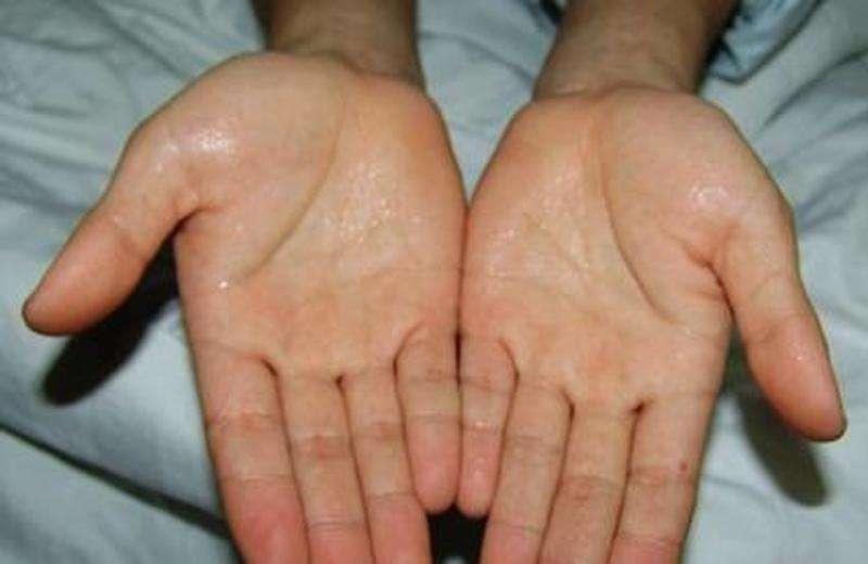 汗是身体健康的晴雨表中医,身体上有5种出汗的值得注意了