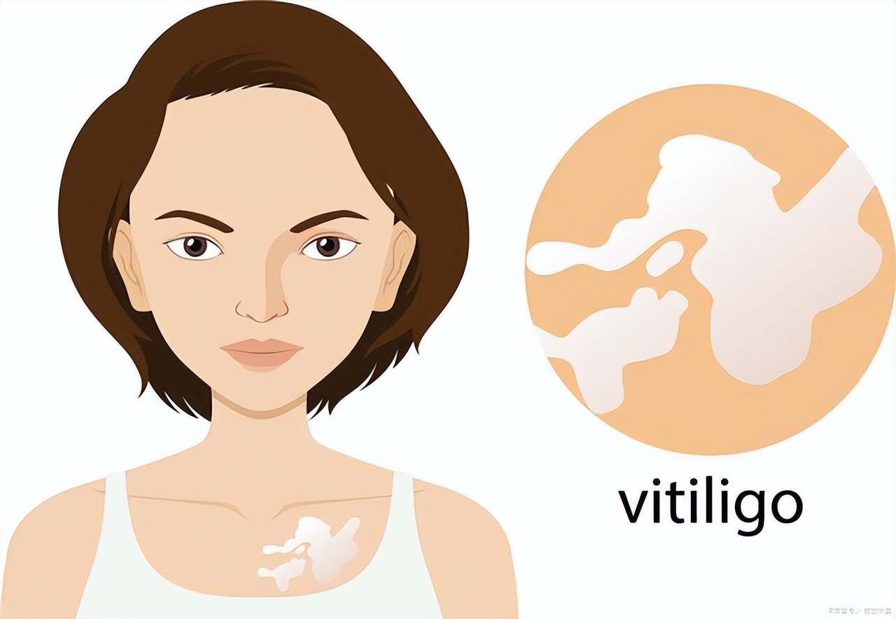 皮肤色素减退和白癜风有什么区别,白癜风是不是色素性皮肤病
