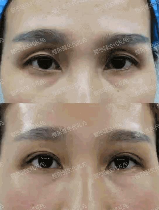 眼窝凹陷眼周脂肪填充眼窝可以吗,眼窝凹陷严重几次眼窝填充好