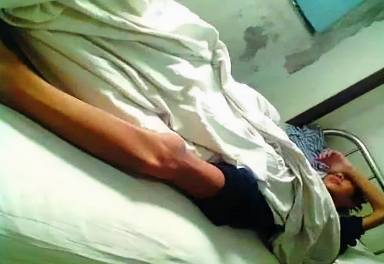 切除一个肾对男性的影响,切除一个肾脏可怕吗