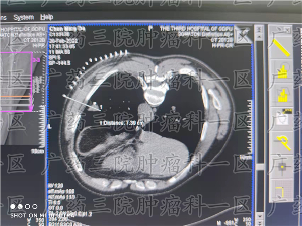 乳房有肿块良性用切除吗,乳房有肿块需要吃药吗