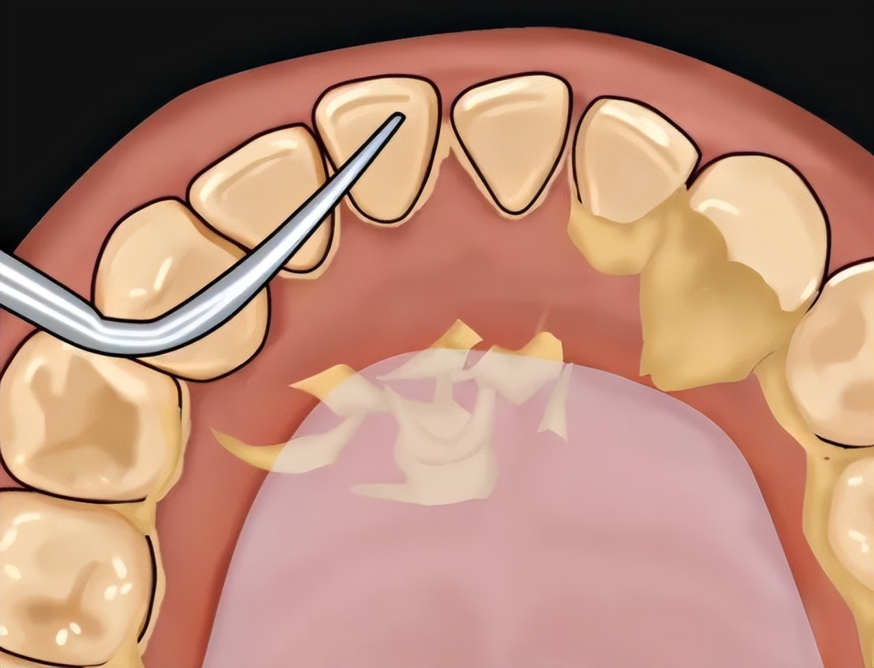 牙结石可以自己抠掉吗,牙结石可以自己抠掉牙根痒怎么办