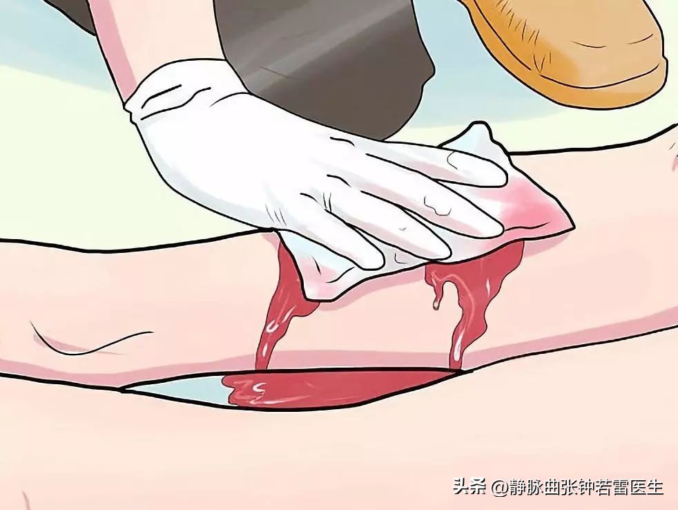 老年人腿上静脉曲张严重瘙痒,老年静脉曲张发黑发痒怎么治疗