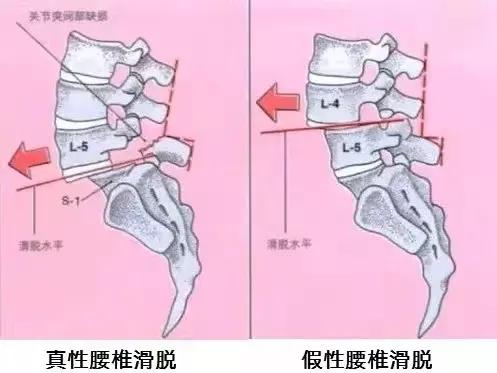 你的腰骨折过吗,你的腰椎