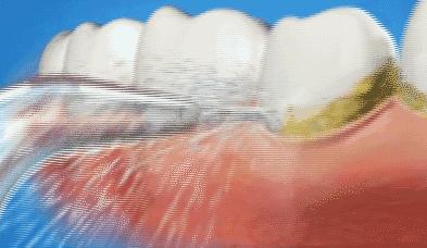 牙有一点点黑线怎么刷掉,所有大牙上都有黑线刷不掉