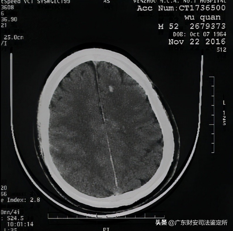 脑部神经损伤司法鉴定需要做哪些,司法鉴定颅内出血是轻伤还是重伤