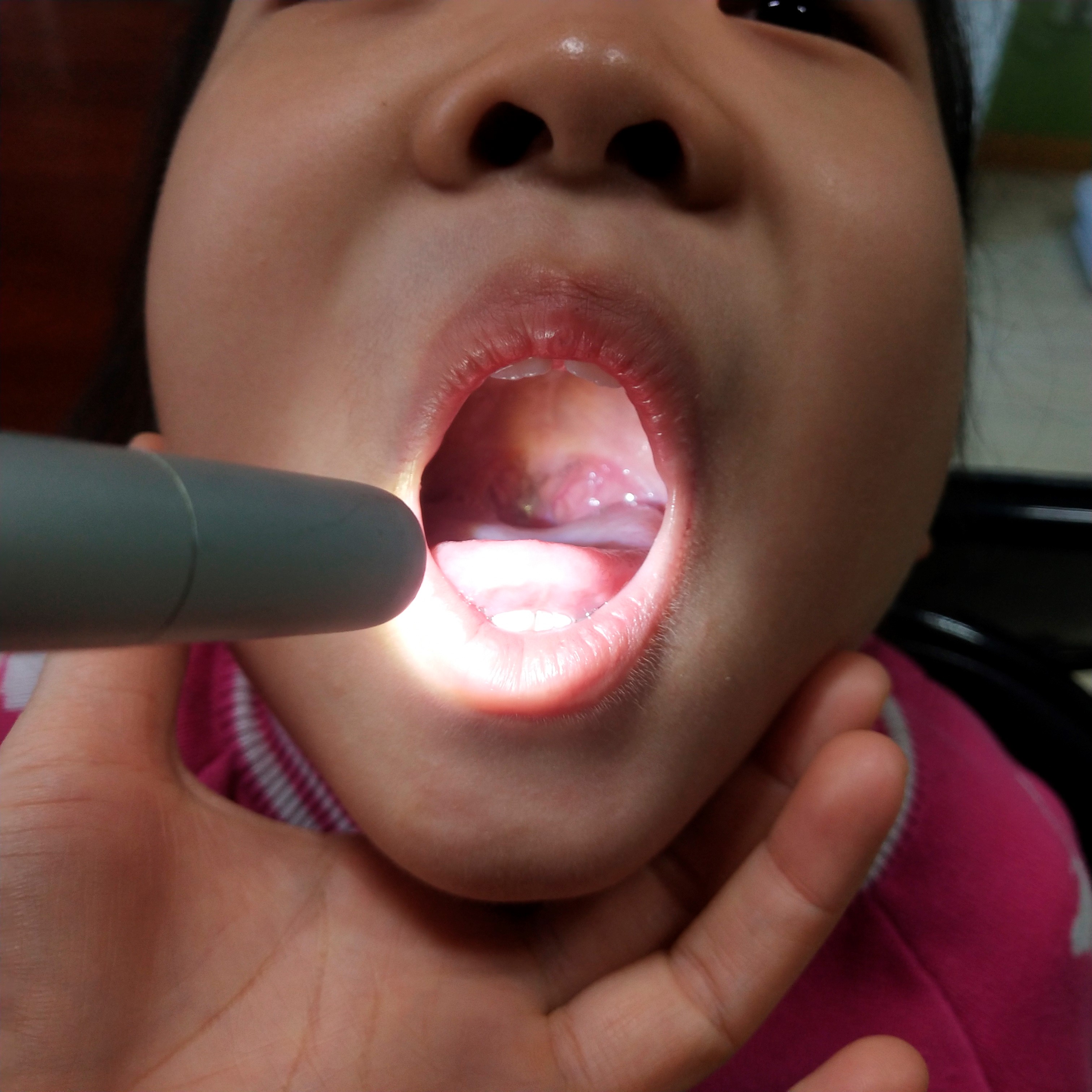 腺样体肥大除了手术还有什么办法,腺样体肥大除了切除还能怎么治