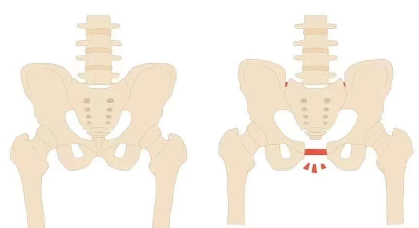 耻骨分离产后会自动闭合吗,生完耻骨分离严重走不了路