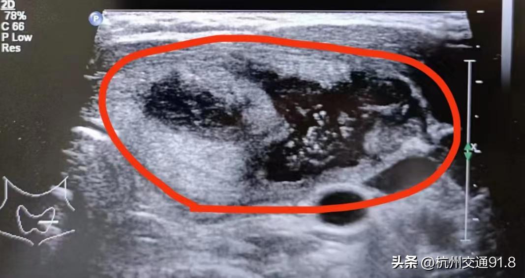 杭州小伙吃完烧烤脖子痛，以为“上火”了，结果是个大“漏”！