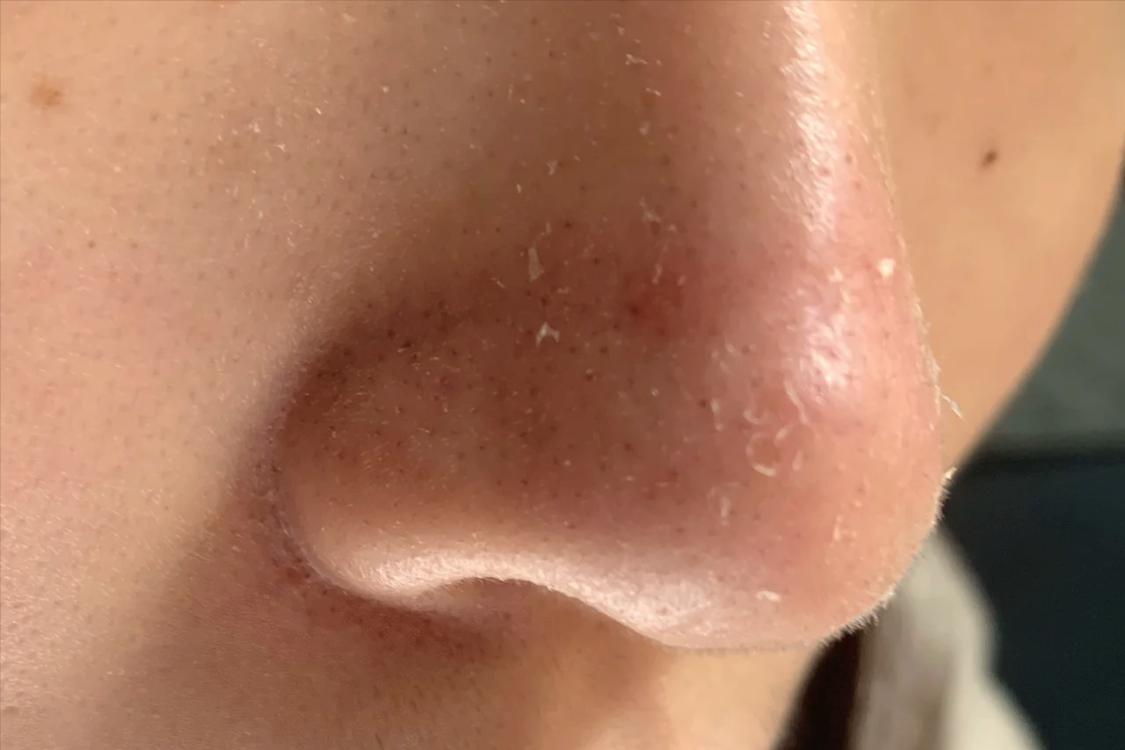 甲硝唑凝胶怎么用最好,甲硝唑凝胶用多久有效