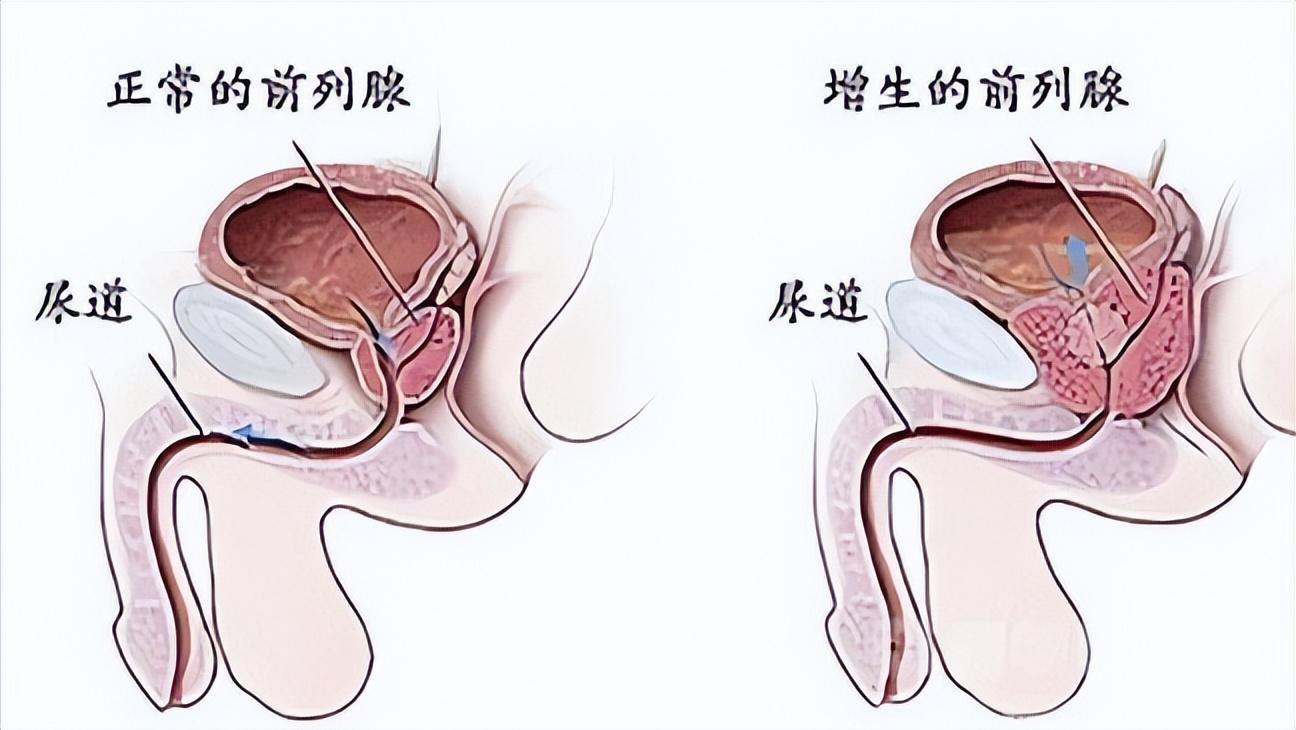网上说前列腺治愈的都是骗人的吗,网上广告治疗前列腺可信吗