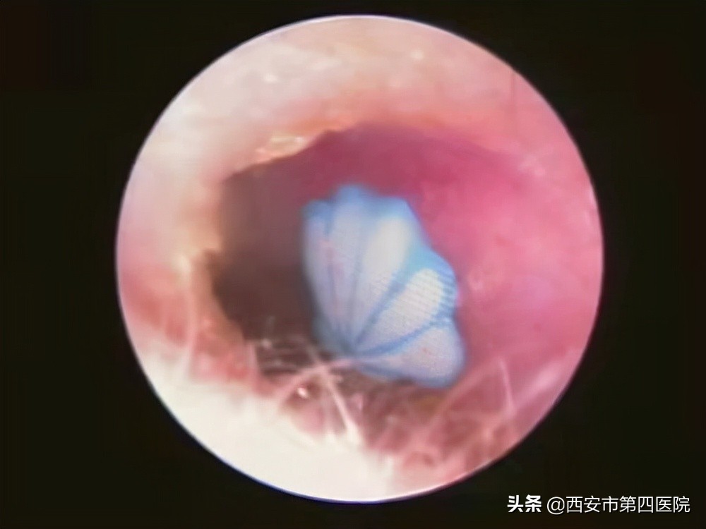 6岁男孩把橡皮擦塞耳朵里怎么办,小孩子用棉签把耳朵给弄流血了