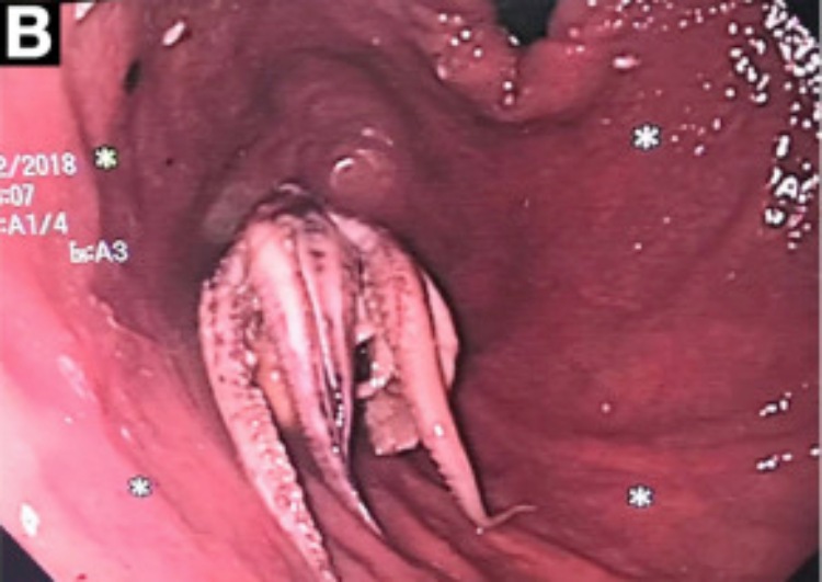 吃活章鱼被卡在喉咙里,章鱼卡住喉咙