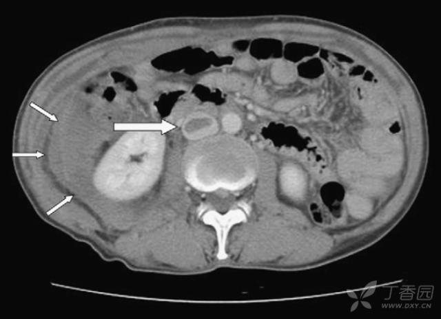 女性右腹部隐痛轻微出血,女性突发性腹部剧痛
