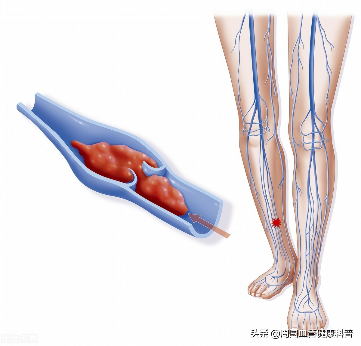下肢深静脉血栓慢性期要注意什么,下肢深静脉血栓后遗症多久能恢复
