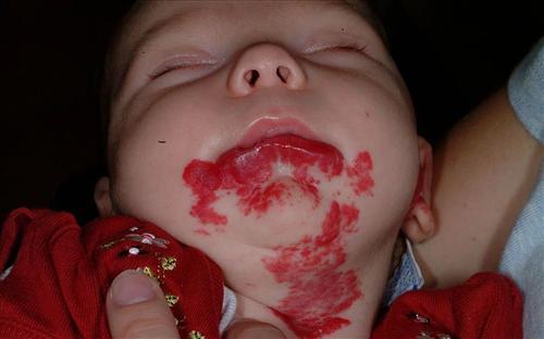 婴幼儿血管瘤有哪几种类型,婴幼儿血管瘤治疗后会留疤吗