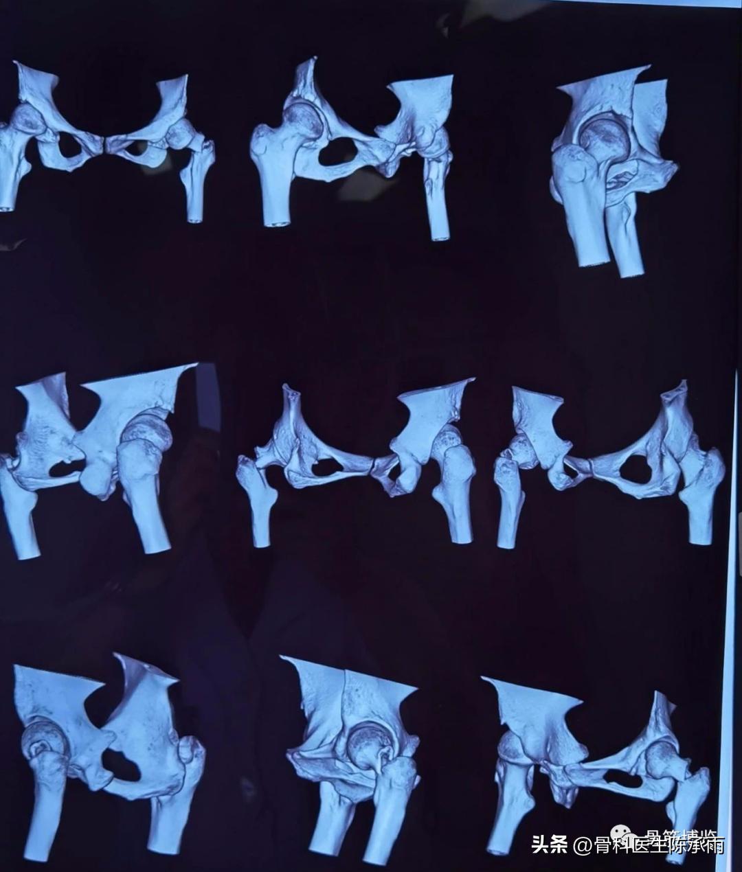 股骨颈闭合复位内固定术后护理,股骨颈骨折闭合复位的技巧