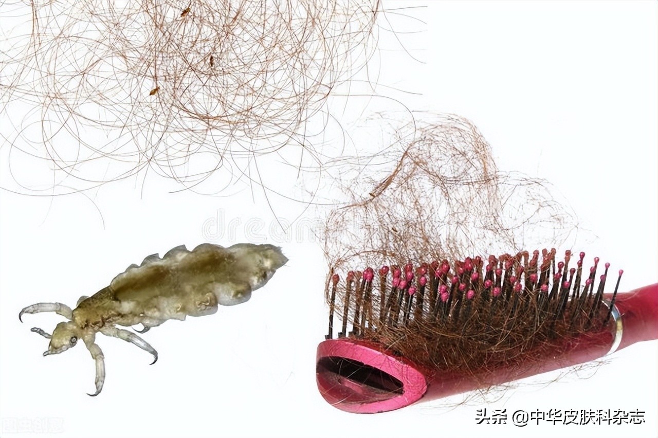 头上长虱子怎么治疗最好,头上长虱子是什么样的