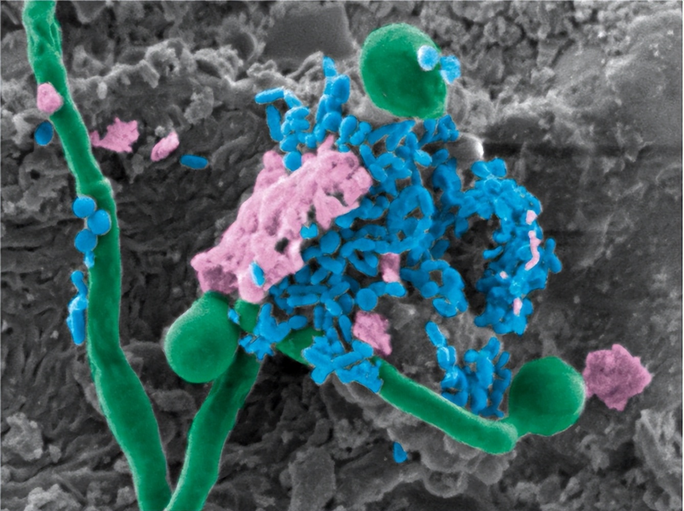 念珠菌真菌感染会引起尿频尿急吗,念珠菌真菌是什么