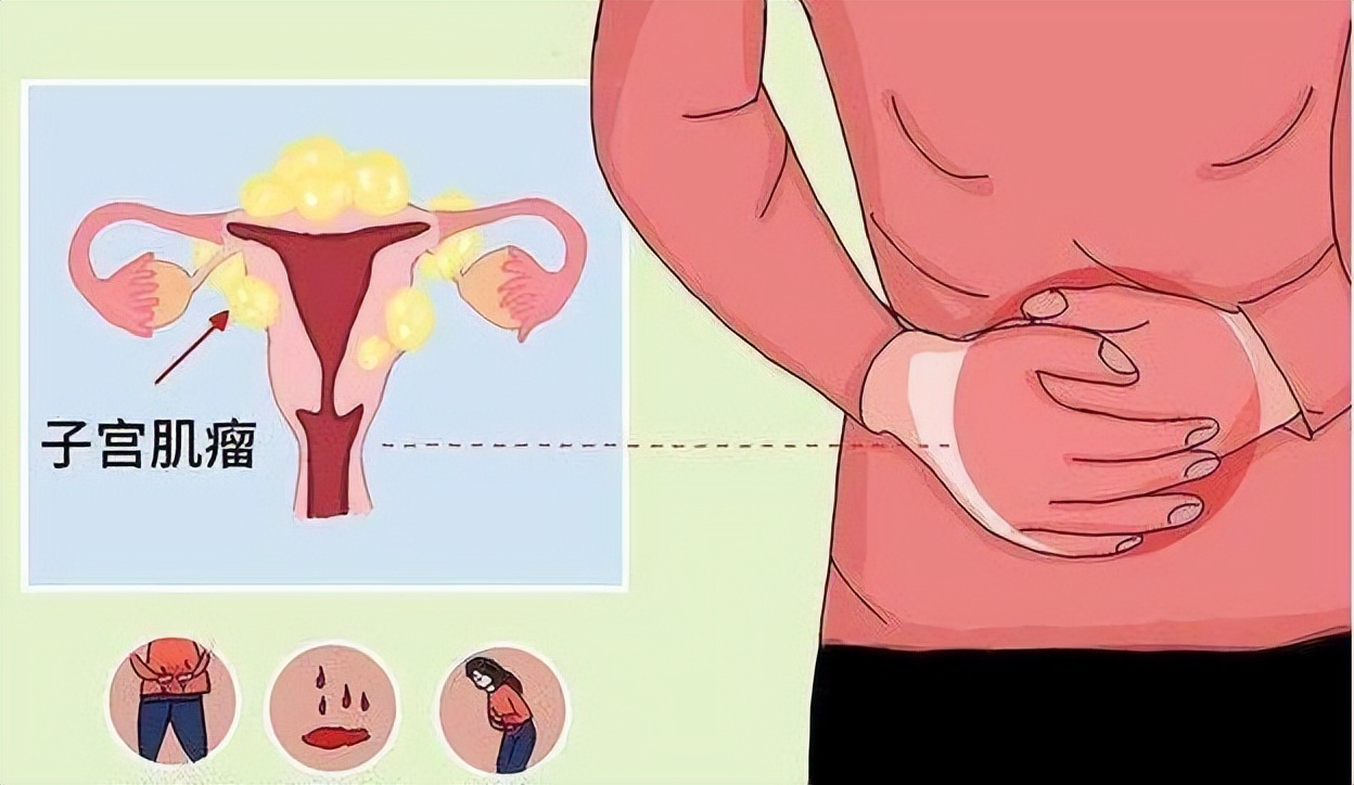 怎么避免长子宫肌瘤,什么情况才会导致长子宫肌瘤