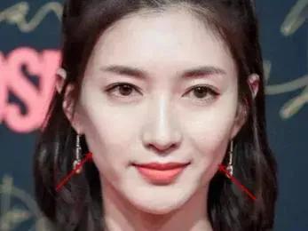 面颊凹陷适合打哪个玻尿酸,脸颊凹陷不饱满