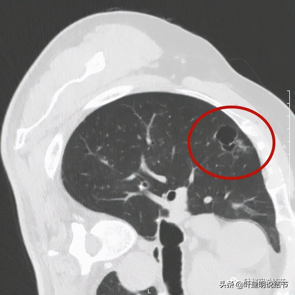肺多发结节切除一个剩下的怎么办,无限纠结的肺小结节