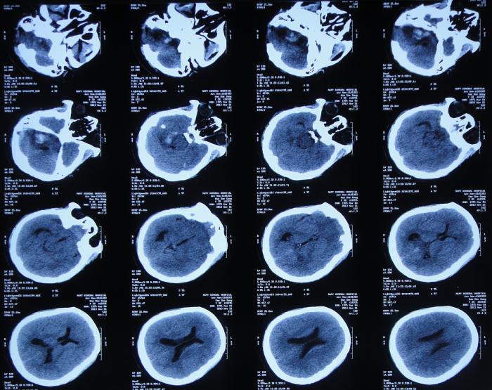 听神经瘤出现脑积水和出血,听神经瘤手术后颅压高症状