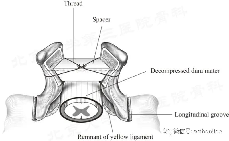 脊髓型颈椎病椎板成形术,椎间盘成形术指征