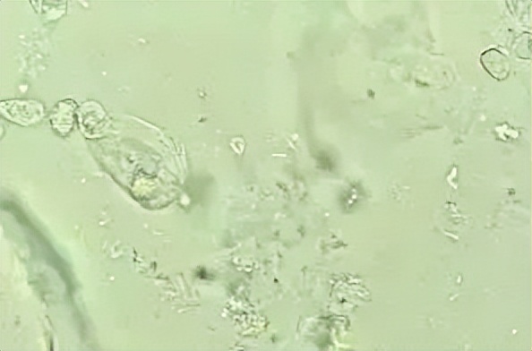 派特灵治妇科病吗,派特灵在妇科怎么使用