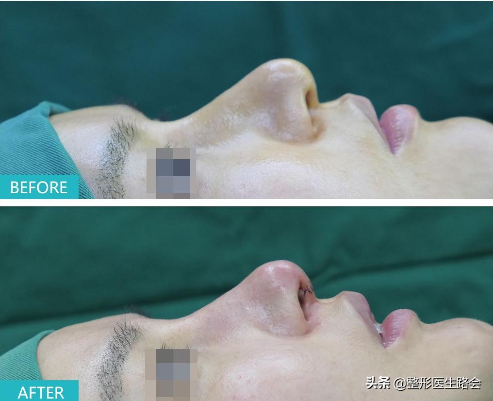 十年隆鼻什么情况下需要重做,10年歪鼻子能修复吗