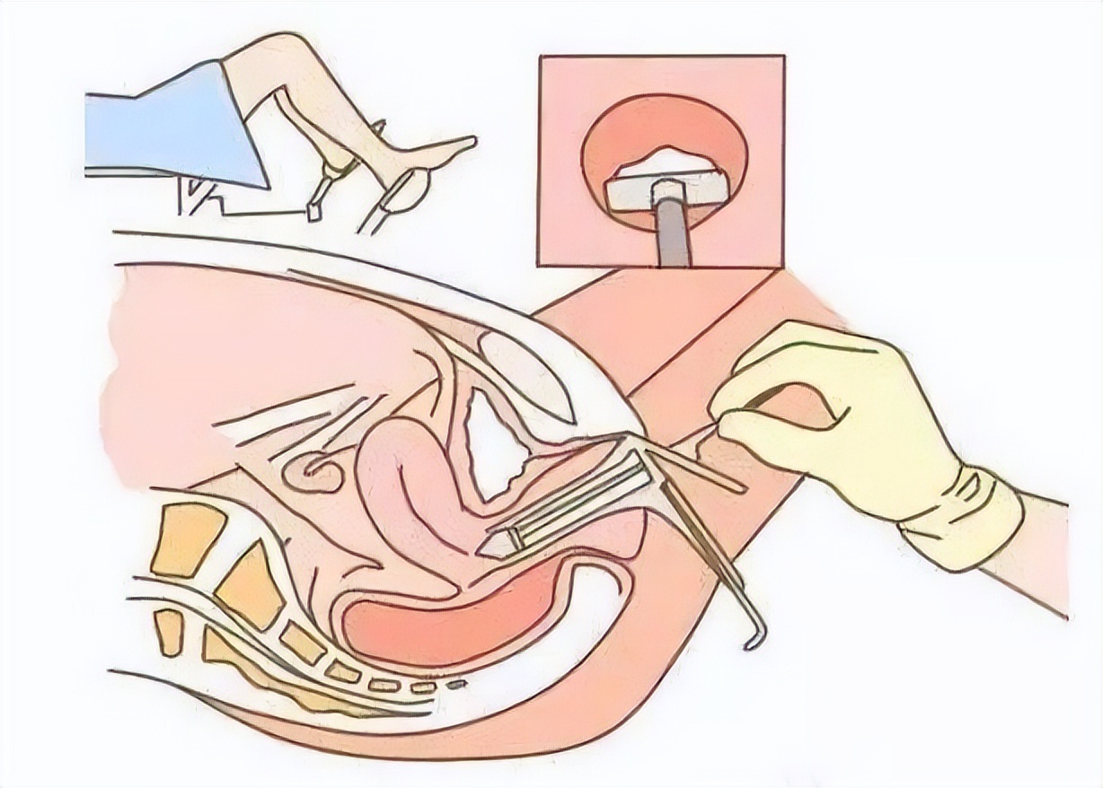 妇科hpv活检要割肉吗,妇科内检需要夹肉化验吗