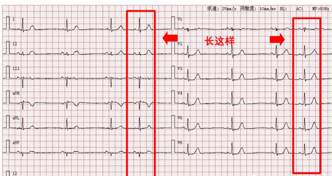 心跳加快不是心动是有病,心跳比较快是心脏病吗