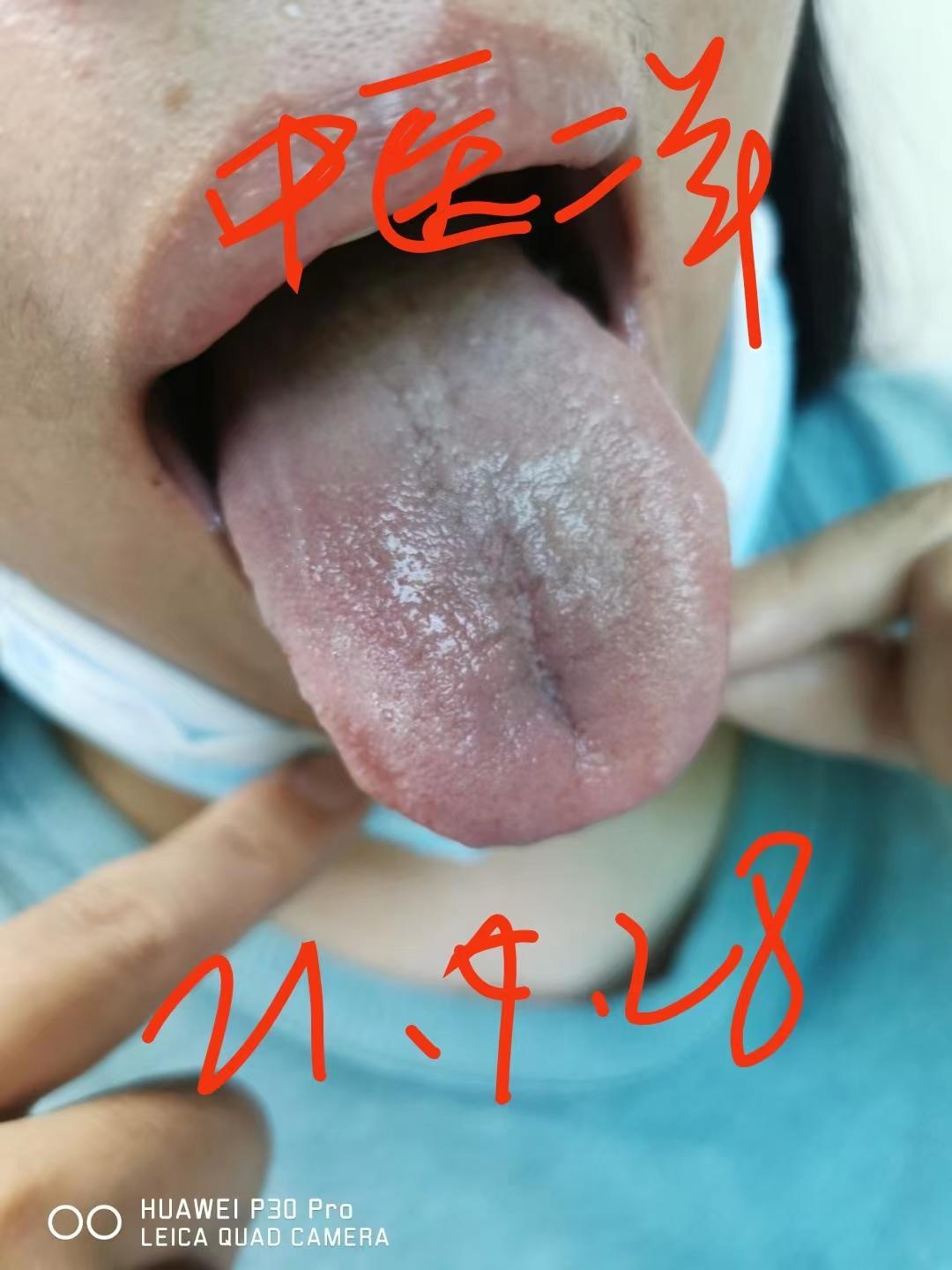 妇科炎症祖传秘方,女性妇科炎症困扰