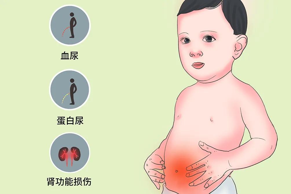 小孩子得了肾炎的症状,孩子肾炎的三大早期症状