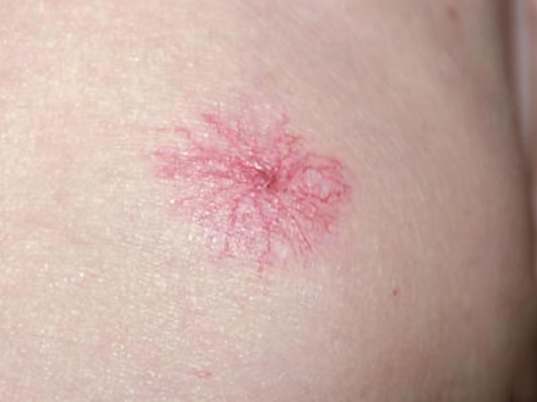 血痣是肝癌早期信号吗,肝癌早期症状看面相