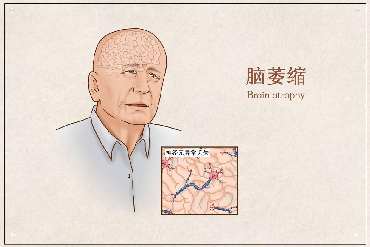 大脑开始萎缩有什么症状,大脑萎缩会有哪些反应