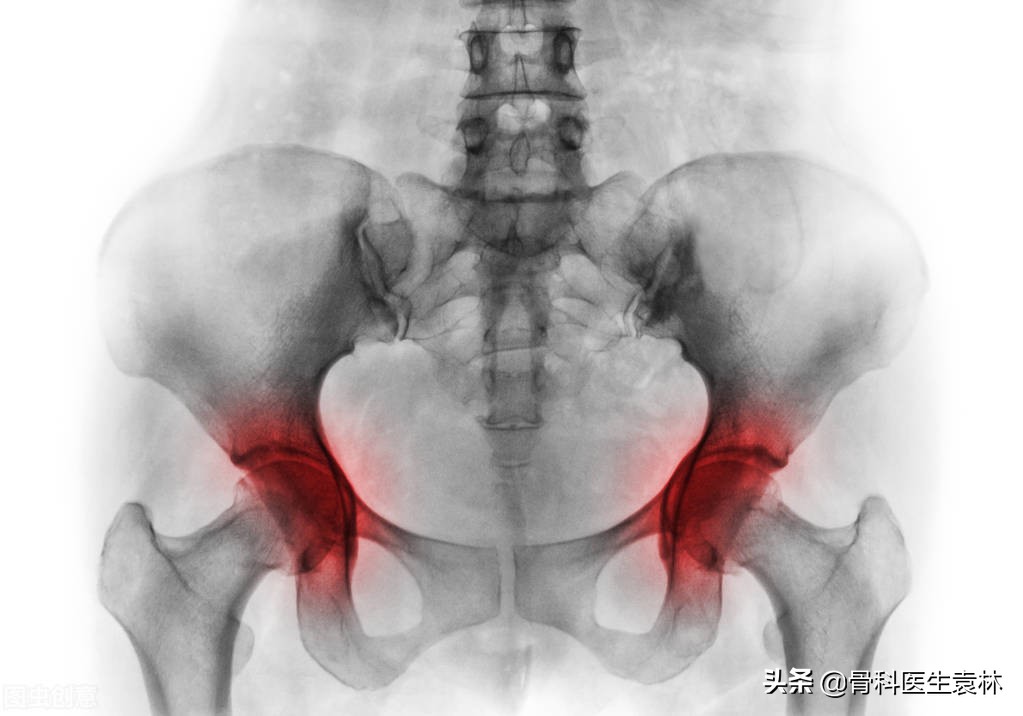 股骨头坏死自测法三大症状要注意,二期股骨头坏死保守治疗症状表现