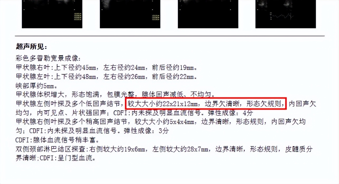 甲状腺结节该如何规范化治疗？