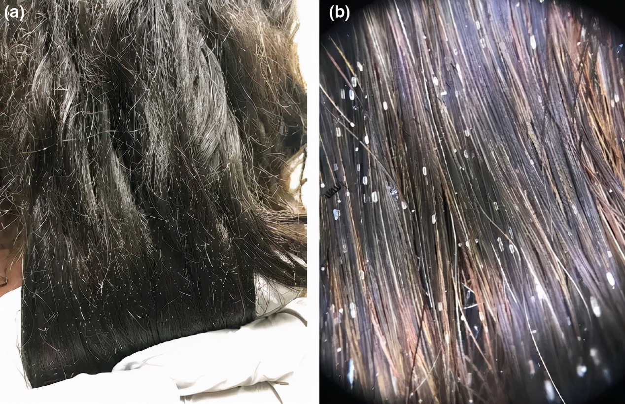 掉的头发根部没有小白点,头发根部小白点掉了还会长吗