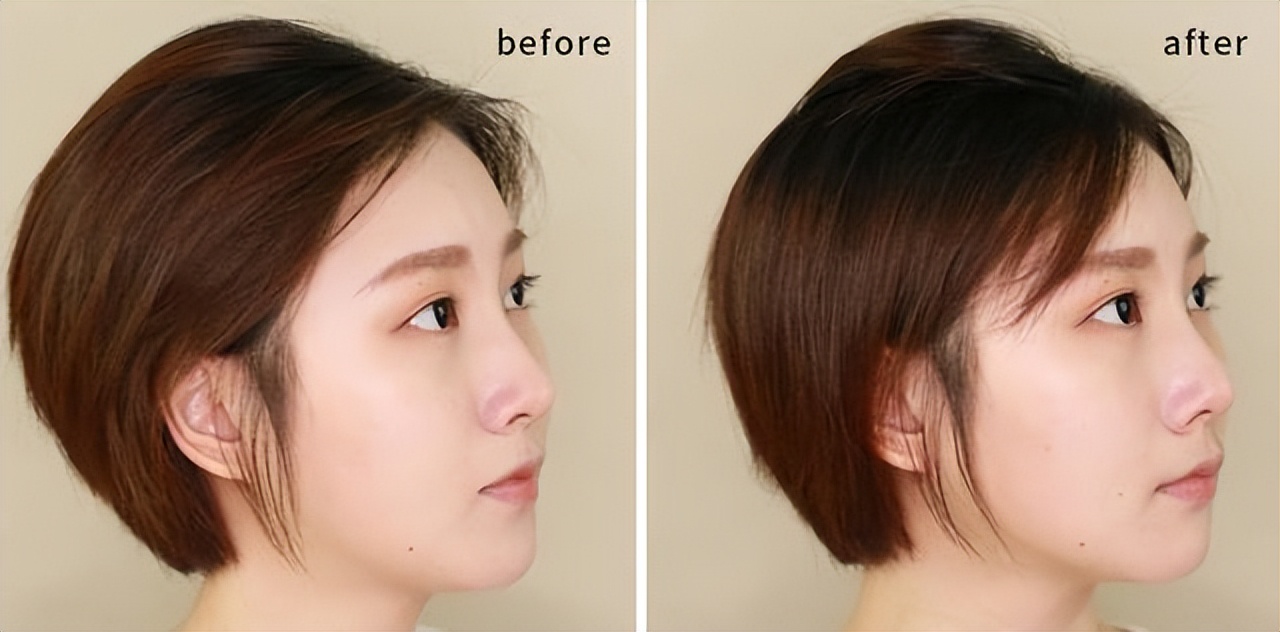 塌鼻子后期能改善吗,塌鼻子怎么改善有效